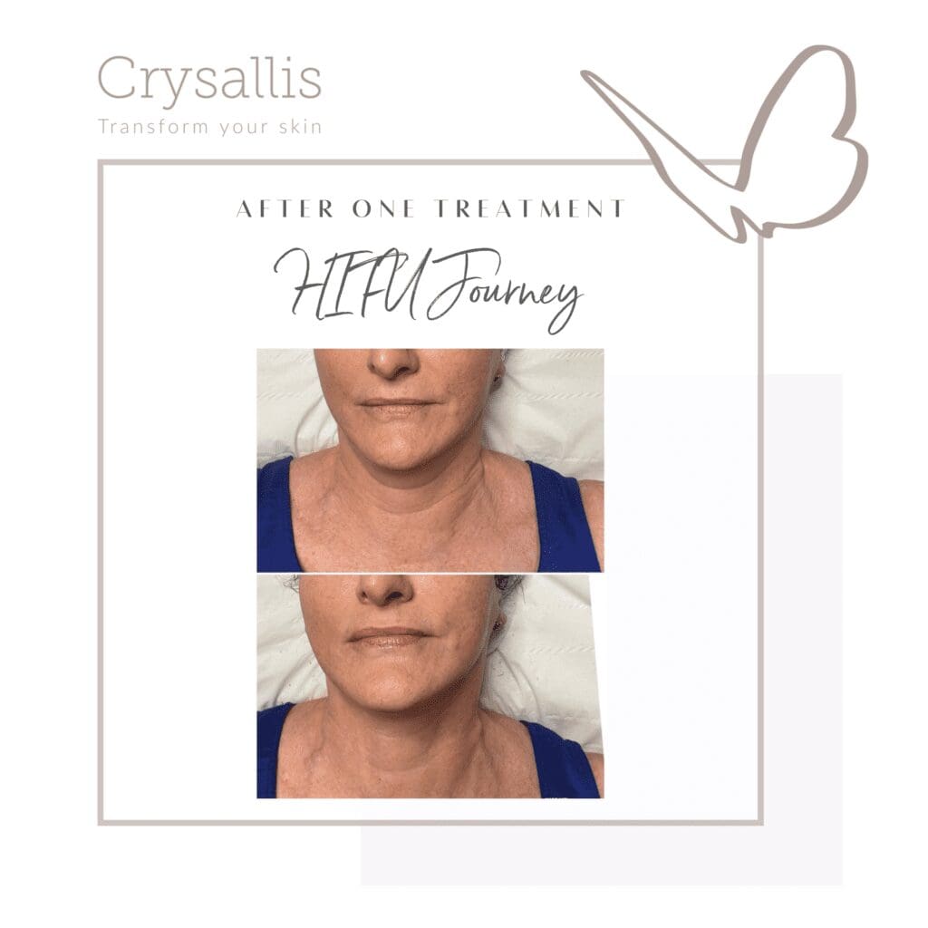 What Is The Lunchtime Facelift? Crysallis Skin Clinic